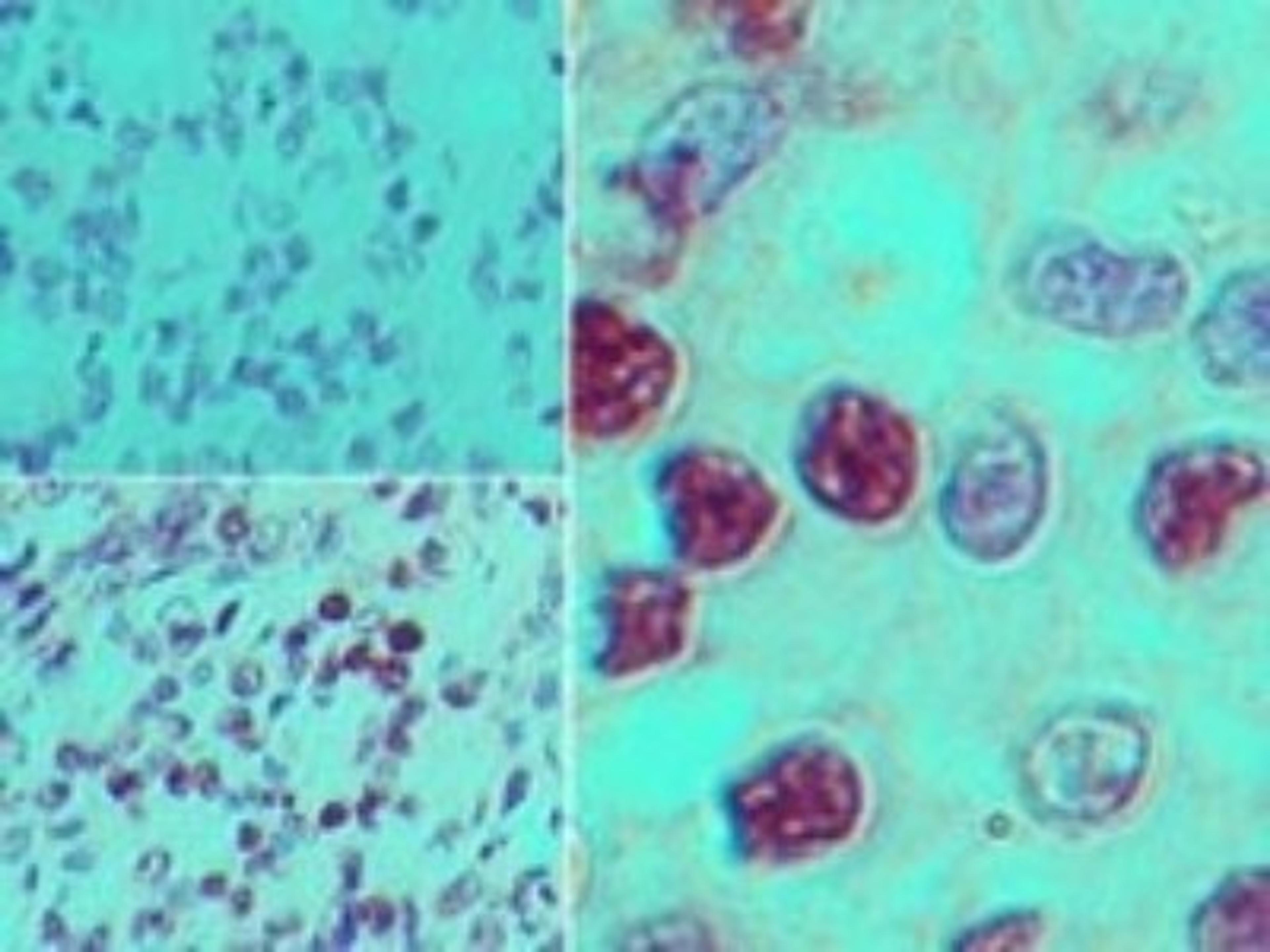 Immunohistochemistry-Paraffin: EBI2/GPR183 Antibody [NBP2-27352] - Analysis of EBI2 in formalin-fixed, paraffin-embedded human stomach tumor tissue using an isotype control (top left) and this antibody (bottom left, right) at 5 ug/ml.