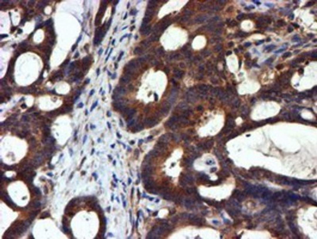 Immunohistochemistry-Paraffin: midA Antibody (4A5) [NBP2-00820] - Staining of paraffin-embedded Adenocarcinoma of Human colon tissue using anti-midA mouse monoclonal antibody.