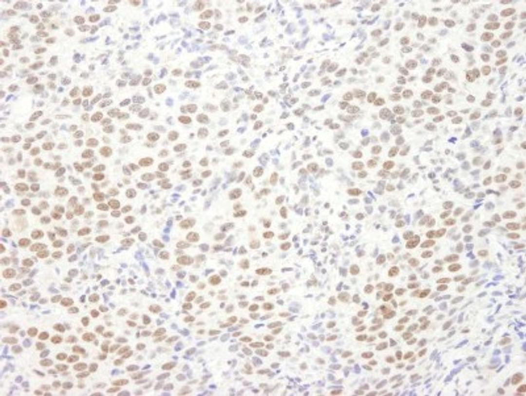 Immunohistochemistry-Paraffin: EWSR1 Antibody [NB200-182] - Human breast carcinoma. Antibody used at a dilution of 1:1,000.