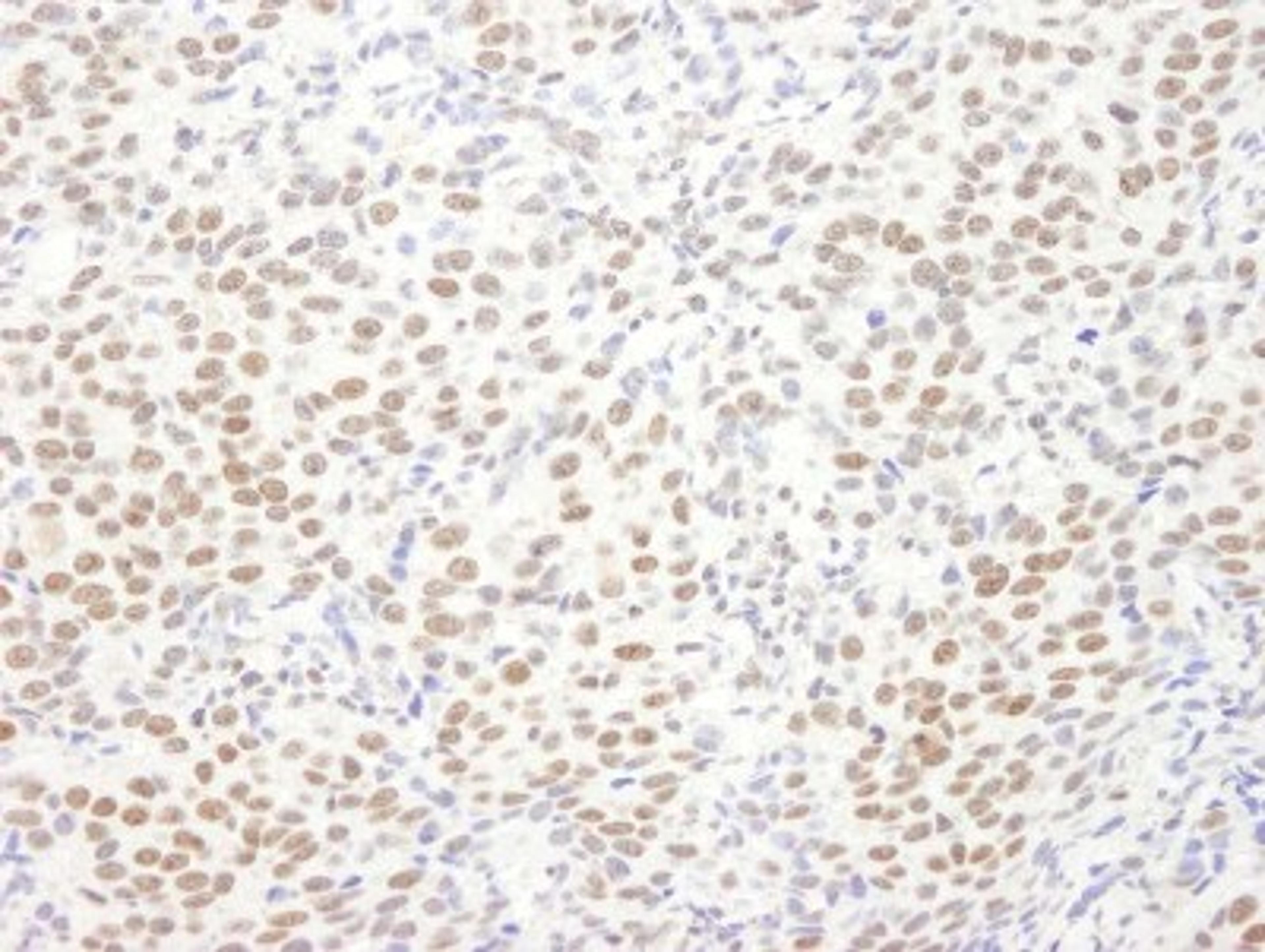 Immunohistochemistry-Paraffin: EWSR1 Antibody [NB200-182] - Human breast carcinoma. Antibody used at a dilution of 1:1,000.