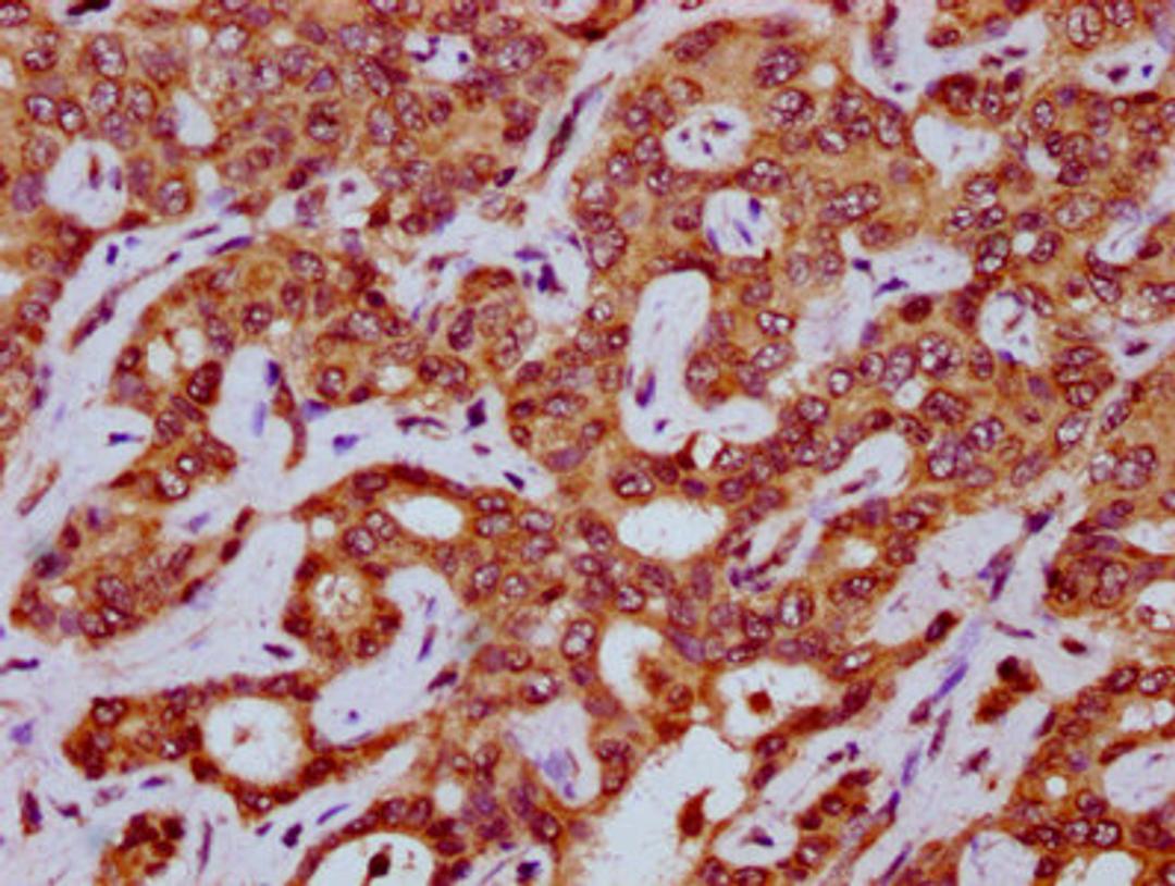 IHC image of CSB-PA773606LA01HU diluted at 1:200 and staining in paraffin-embedded human liver cancer performed on a Leica BondTM system. After dewaxing and hydration, antigen retrieval was mediated by high pressure in a citrate buffer (pH 6.0). Section was blocked with 10% normal goat serum 30min at RT. Then primary antibody (1% BSA) was incubated at 4&deg;C overnight. The primary is detected by a biotinylated secondary antibody and visualized using an HRP conjugated SP system.