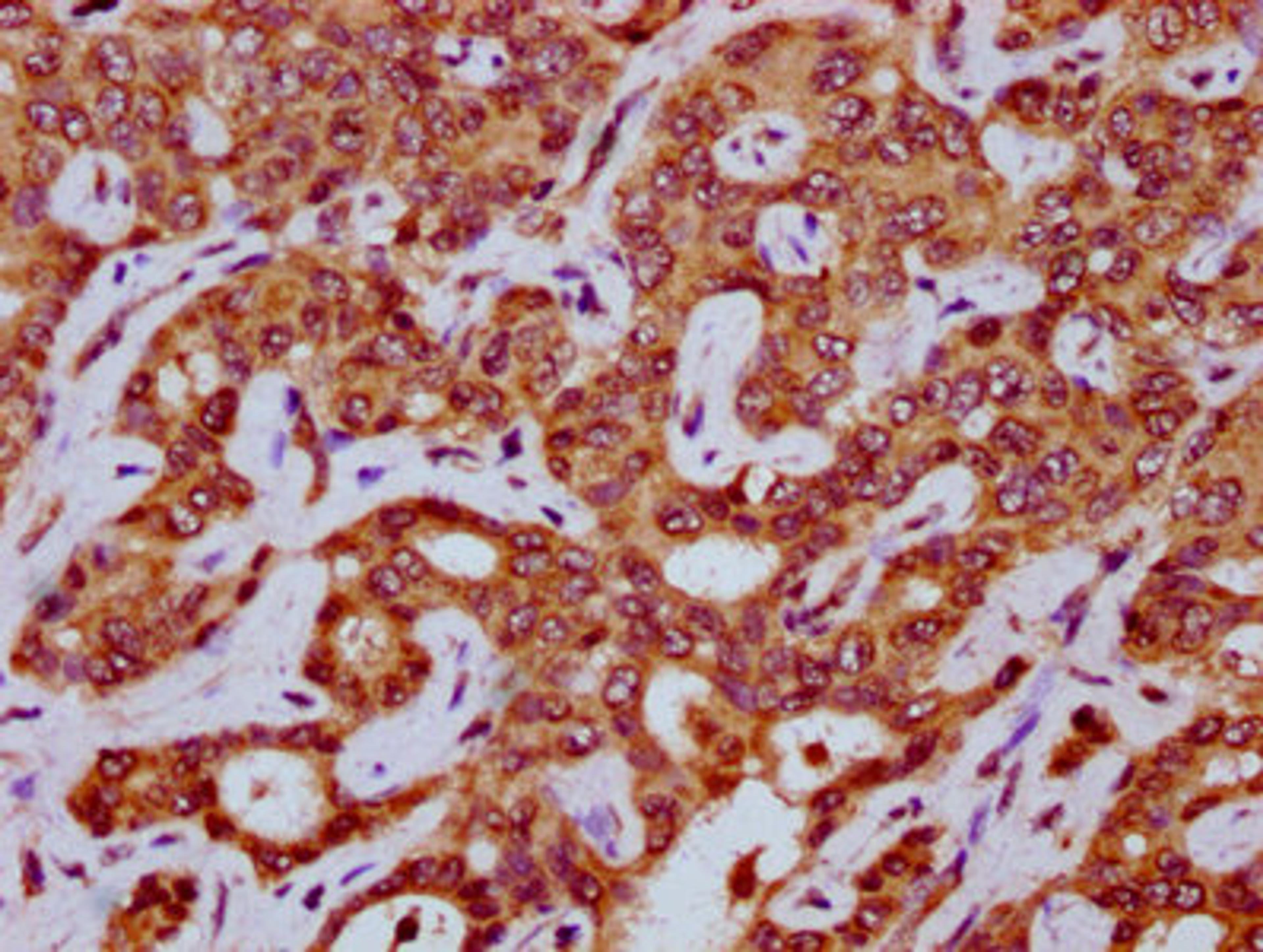 IHC image of CSB-PA773606LA01HU diluted at 1:200 and staining in paraffin-embedded human liver cancer performed on a Leica BondTM system. After dewaxing and hydration, antigen retrieval was mediated by high pressure in a citrate buffer (pH 6.0). Section was blocked with 10% normal goat serum 30min at RT. Then primary antibody (1% BSA) was incubated at 4&deg;C overnight. The primary is detected by a biotinylated secondary antibody and visualized using an HRP conjugated SP system.