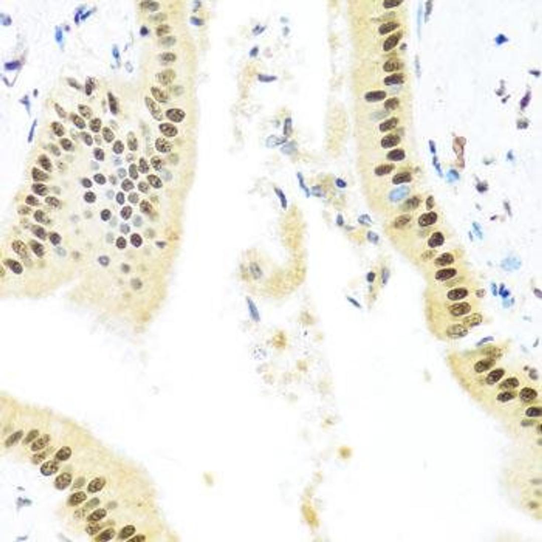 Immunohistochemical staining of human liver injury tissue using ZBTB17 antibody (dilution of 1:100)