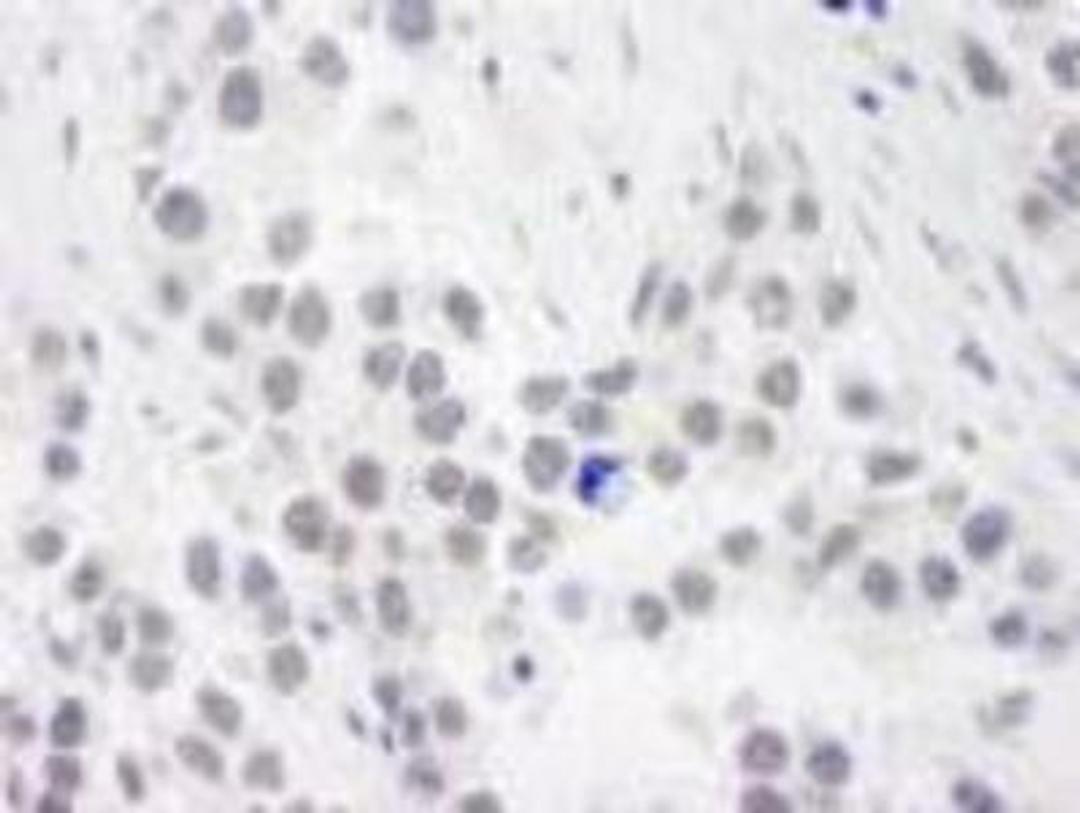 Immunohistochemistry-Paraffin: RPA70 Antibody [NB100-2204] - FFPE section of human seminoma.   Affinity purified rabbit anti-RPA70 used at a dilution of 1:250.