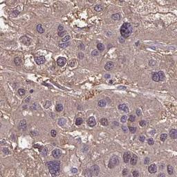 Immunohistochemistry: TTC9C Antibody [NBP2-31595] - liver cancer