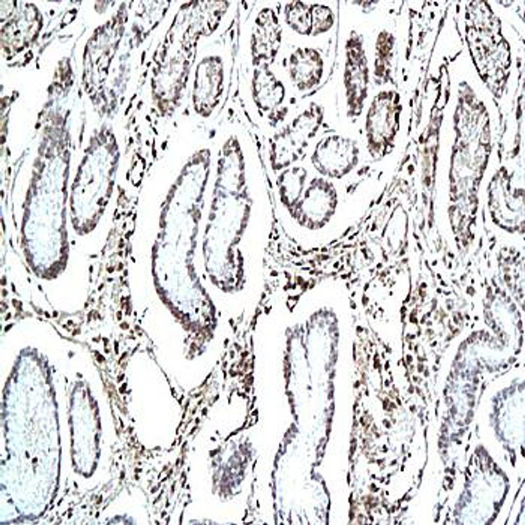 Immunohistochemical analysis of formalin-fixed and paraffin embedded human ovarian cancer tissue using HLA DR antibody