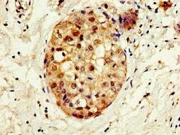 Immunohistochemistry of paraffin-embedded human breast cancer using CSB-PA838805LA01HU at dilution of 1:100