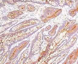 IHC testing of human colon carcinoma stained with CEA antibody (COL-1).