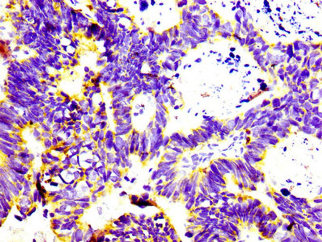 IHC image of CSB-RA004956A0HU diluted at 1:100 and staining in paraffin-embedded human ovarian cancer performed on a Leica BondTM system. After dewaxing and hydration, antigen retrieval was mediated by high pressure in a citrate buffer (pH 6.0). Section was blocked with 10% normal goat serum 30min at RT. Then primary antibody (1% BSA) was incubated at 4°C overnight. The primary is detected by a biotinylated secondary antibody and visualized using an HRP conjugated SP system.