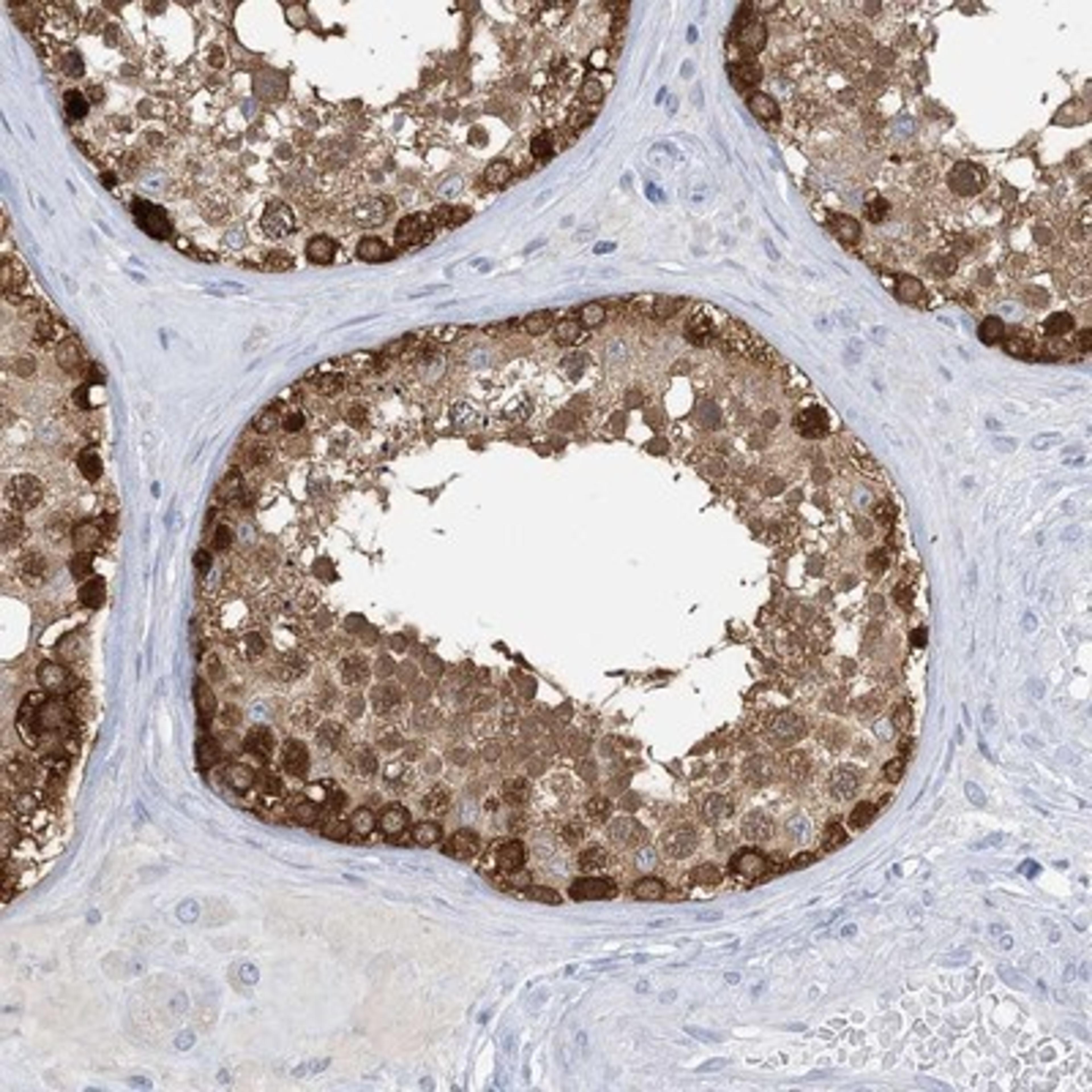 Immunohistochemistry-Paraffin: TKTL1 Antibody [NBP1-86939] - Immunohistochemical staining of human testis shows strong cytoplasmic positivity with a granular pattern in seminiferous duct cells.