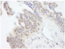 Immunohistochemistry-Paraffin: ABI1 Antibody [NB100-59845] - Detection of Human ABI1  Sample: FFPE section of human ovarian carcinoma. Affinity purified rabbit anti-ABI1 at a dilution of 1:250. DAB staining using IHC Accessory Kit .