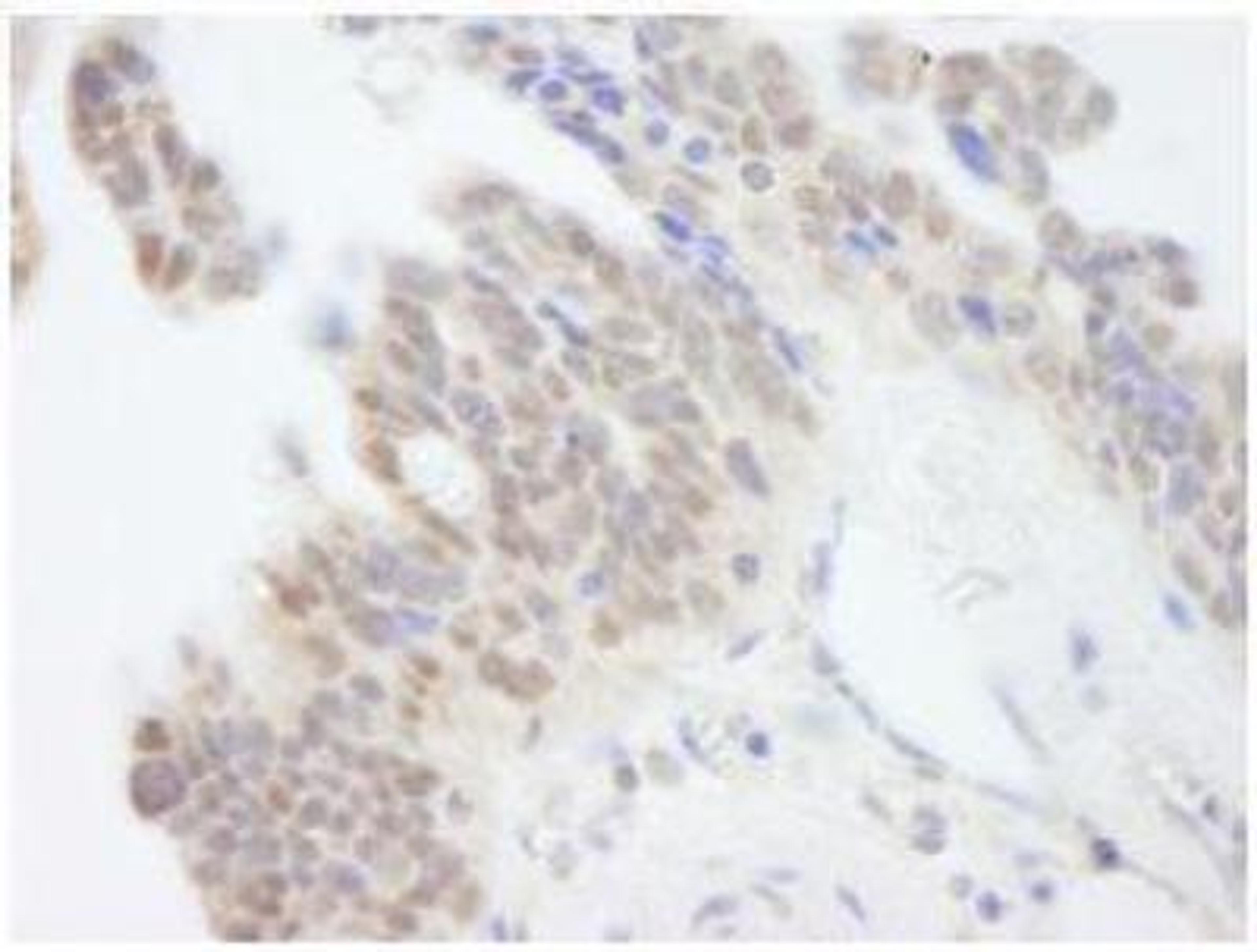 Immunohistochemistry-Paraffin: ABI1 Antibody [NB100-59845] - Detection of Human ABI1  Sample: FFPE section of human ovarian carcinoma. Affinity purified rabbit anti-ABI1 at a dilution of 1:250. DAB staining using IHC Accessory Kit .