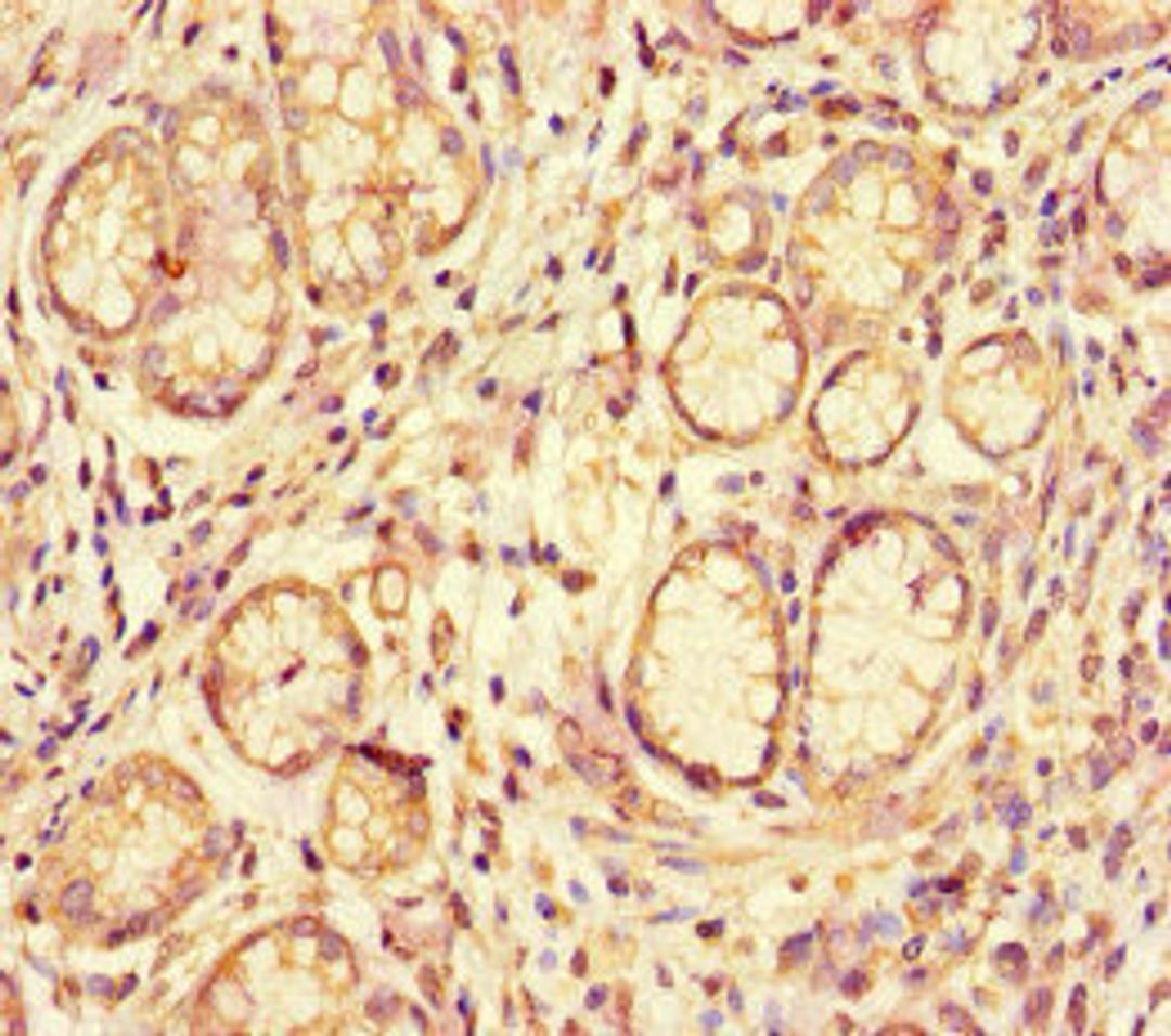 Immunohistochemistry of paraffin-embedded human gastric cancer using CSB-PA866317LA01HU at dilution of 1:100