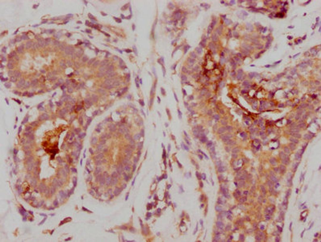 IHC image of CSB-RA014679A0HU diluted at 1:235 and staining in paraffin-embedded human breast cancer performed on a Leica BondTM system. After dewaxing and hydration, antigen retrieval was mediated by high pressure in a citrate buffer (pH 6.0). Section was blocked with 10% normal goat serum 30min at RT. Then primary antibody (1% BSA) was incubated at 4℃ overnight. The primary is detected by a biotinylated secondary antibody and visualized using an HRP conjugated SP system.