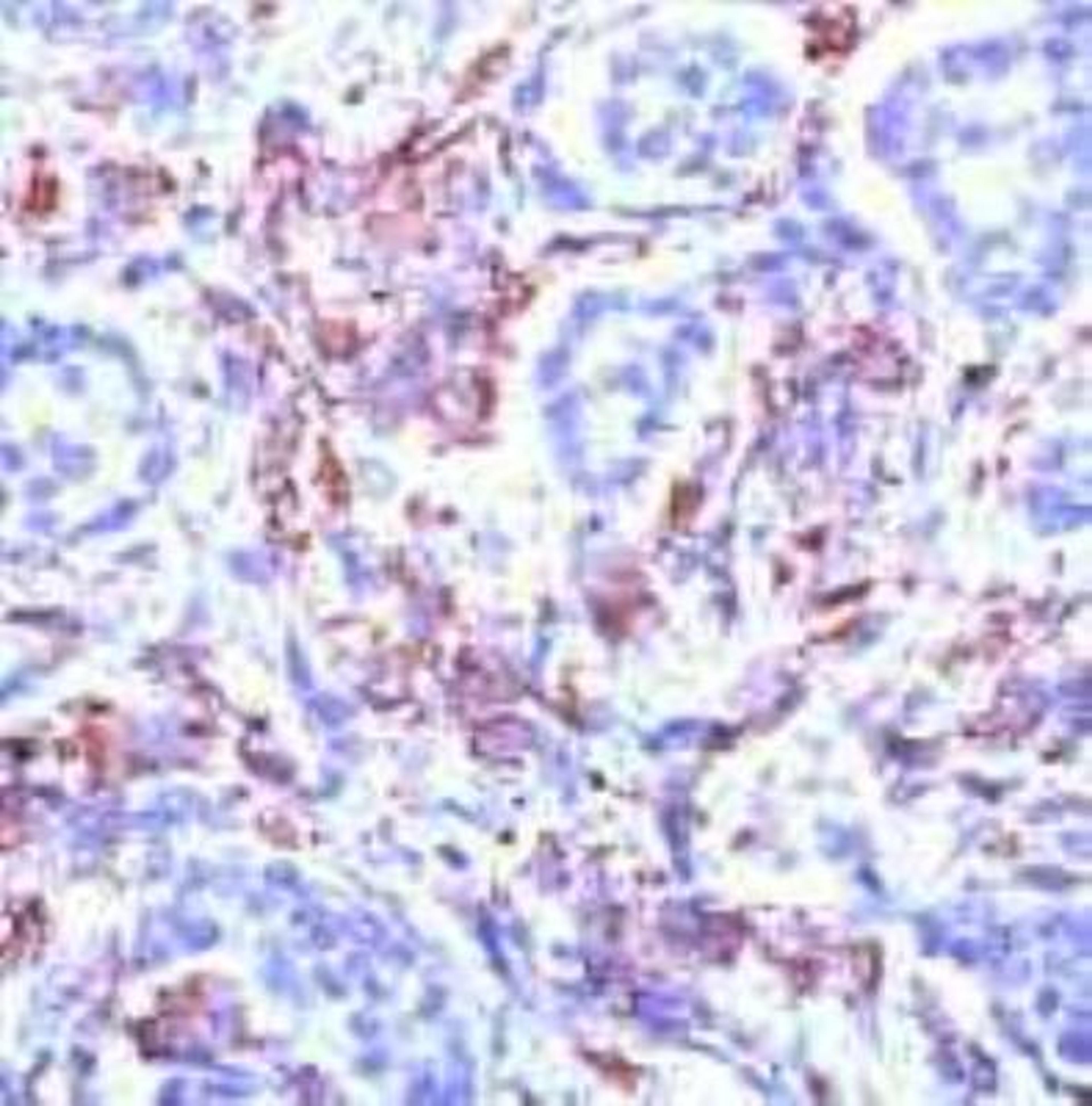 Immunohistochemistry: Phosphoserine/Phosphothreonine/Phosphotyrosine Antibody (SPM101) [NB600-558] - Man breast carcinoma stained with anti-phospho pan, NB 600-558.  (FFPE-sections).