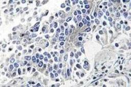 Immunohistochemistry: JNK/JIP3 Antibody [NBP1-00895] - Immunohistochemistry (IHC) analyzes of JIP3 (Q649) antibody in paraffin-embedded human lung carcinoma tissue.