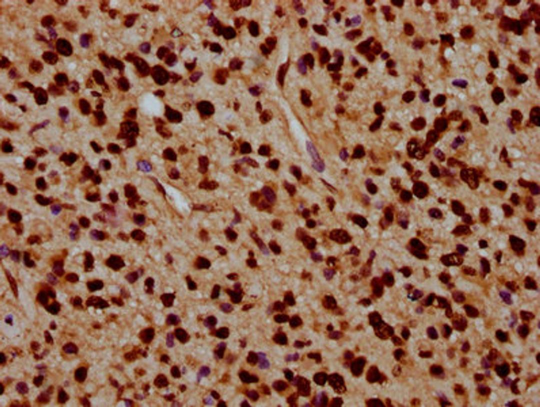 IHC image of CSB-PA010429OA91nacHU diluted at 1:5 and staining in paraffin-embedded human glioma performed on a Leica BondTM system. After dewaxing and hydration, antigen retrieval was mediated by high pressure in a citrate buffer (pH 6.0). Section was blocked with 10% normal goat serum 30min at RT. Then primary antibody (1% BSA) was incubated at 4°C overnight. The primary is detected by a biotinylated secondary antibody and visualized using an HRP conjugated SP system.