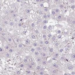 Immunohistochemistry: LOC285141 Antibody [NBP2-31655] - liver cancer