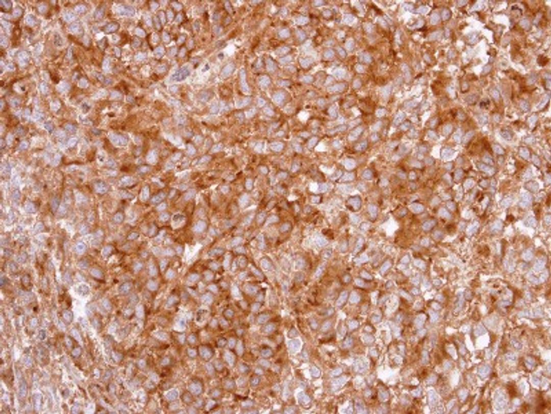 Immunohistochemistry-Paraffin: GHSR Antibody [NBP2-16655] - Immunohistochemical analysis of paraffin-embedded CL1-0 xenograft, using antibody at 1:100 dilution.