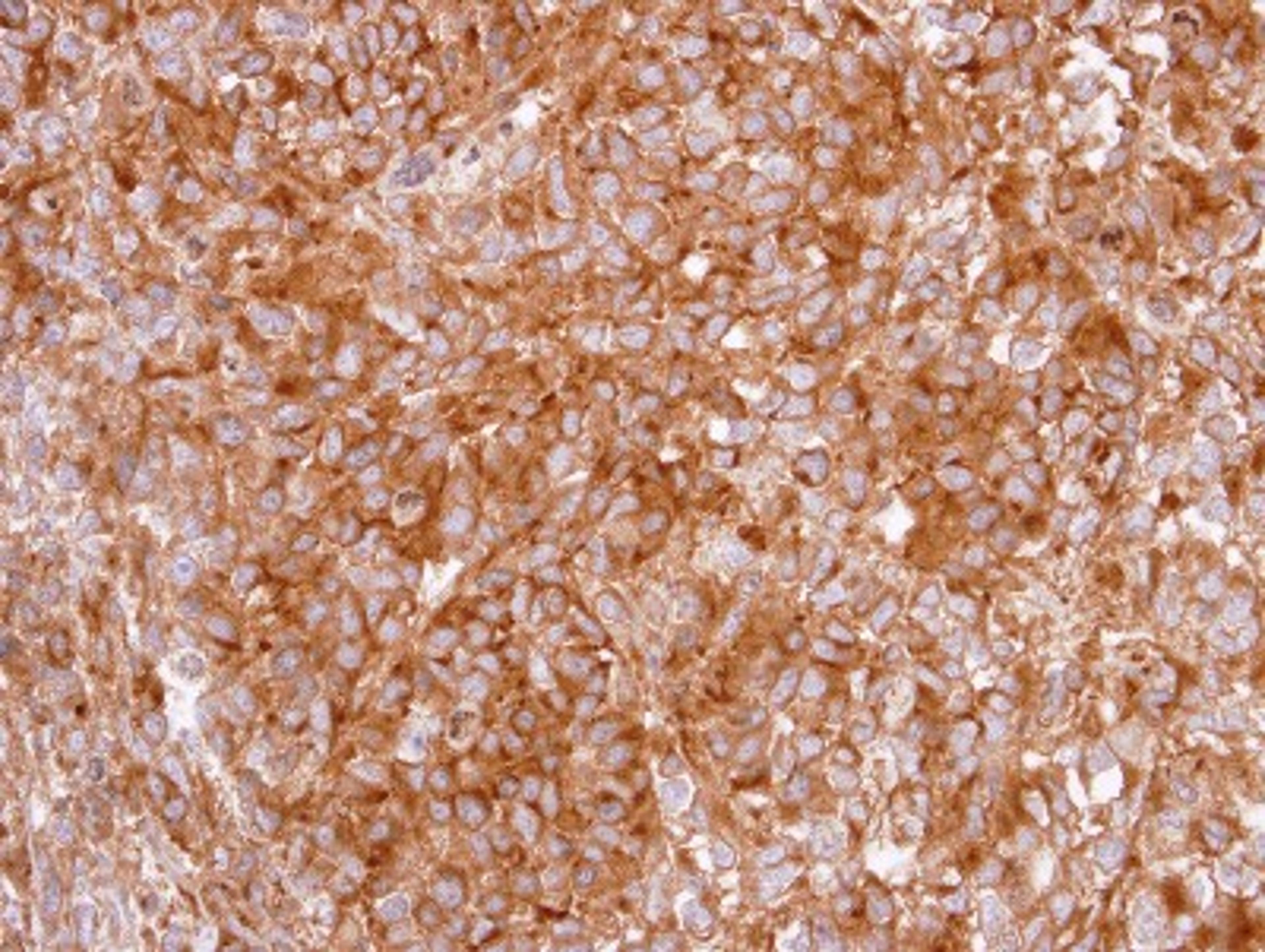 Immunohistochemistry-Paraffin: GHSR Antibody [NBP2-16655] - Immunohistochemical analysis of paraffin-embedded CL1-0 xenograft, using antibody at 1:100 dilution.