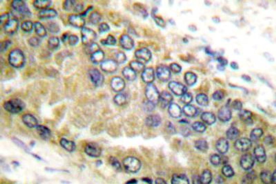 Immunohistochemistry-Paraffin: TGF beta 2 Antibody - Analysis in Human lung carcinoma tissue.