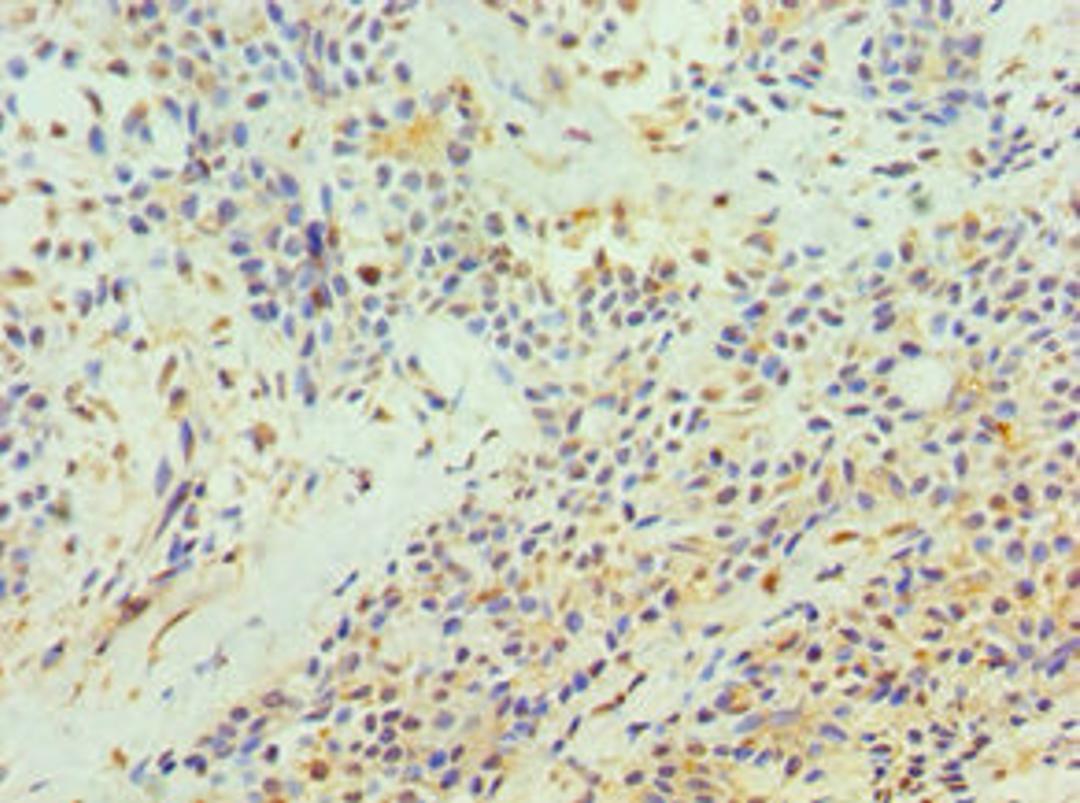 Immunohistochemistry of paraffin-embedded human breast cancer using CSB-PA023438DSR1HU at dilution of 1:100