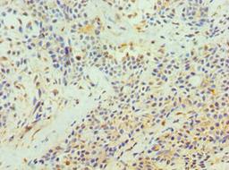 Immunohistochemistry of paraffin-embedded human breast cancer using CSB-PA023438DSR1HU at dilution of 1:100