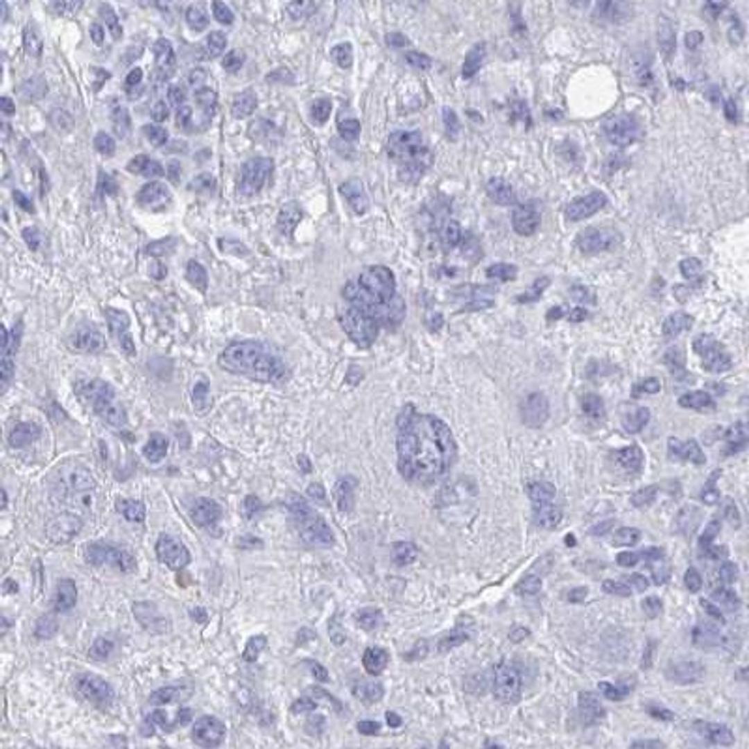 Immunohistochemistry: PRDM7 Antibody [NBP2-32504] - liver cancer