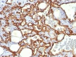 Formalin-fixed, paraffin-embedded human Angiosarcoma stained with anti-CD31 antibody (SPM532)