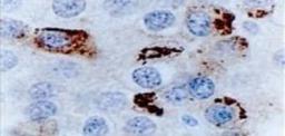 Immunohistochemistry-Paraffin: Bcl-Xl Antibody [NB100-56104] - Analysis of Bcl-X in human breast carcinoma at 1:2000. A. Formalin-fixed, paraffin-embedded tissue section from invasive ductal carcinoma. An organellar/mitochondrial pattern of Bcl-X staining is observed in the cytosol of tumor cells.  B. Western blot analysis of tissue lysates from breast surgical tumor tissue biopsies (Lanes 1-7) .  Bcl-XS is not detected and variable amounts of Bcl-XL (~30 kDa) is is detected. Lane 8. Recombinant Bcl-XL (positive control).