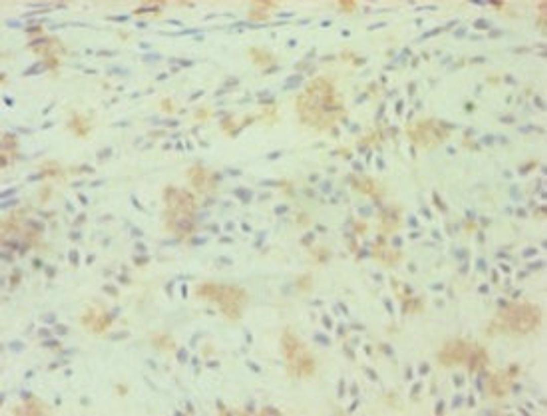 Immunohistochemistry of paraffin-embedded human breast cancer using CSB-PA020071LA01HU at dilution of 1:100