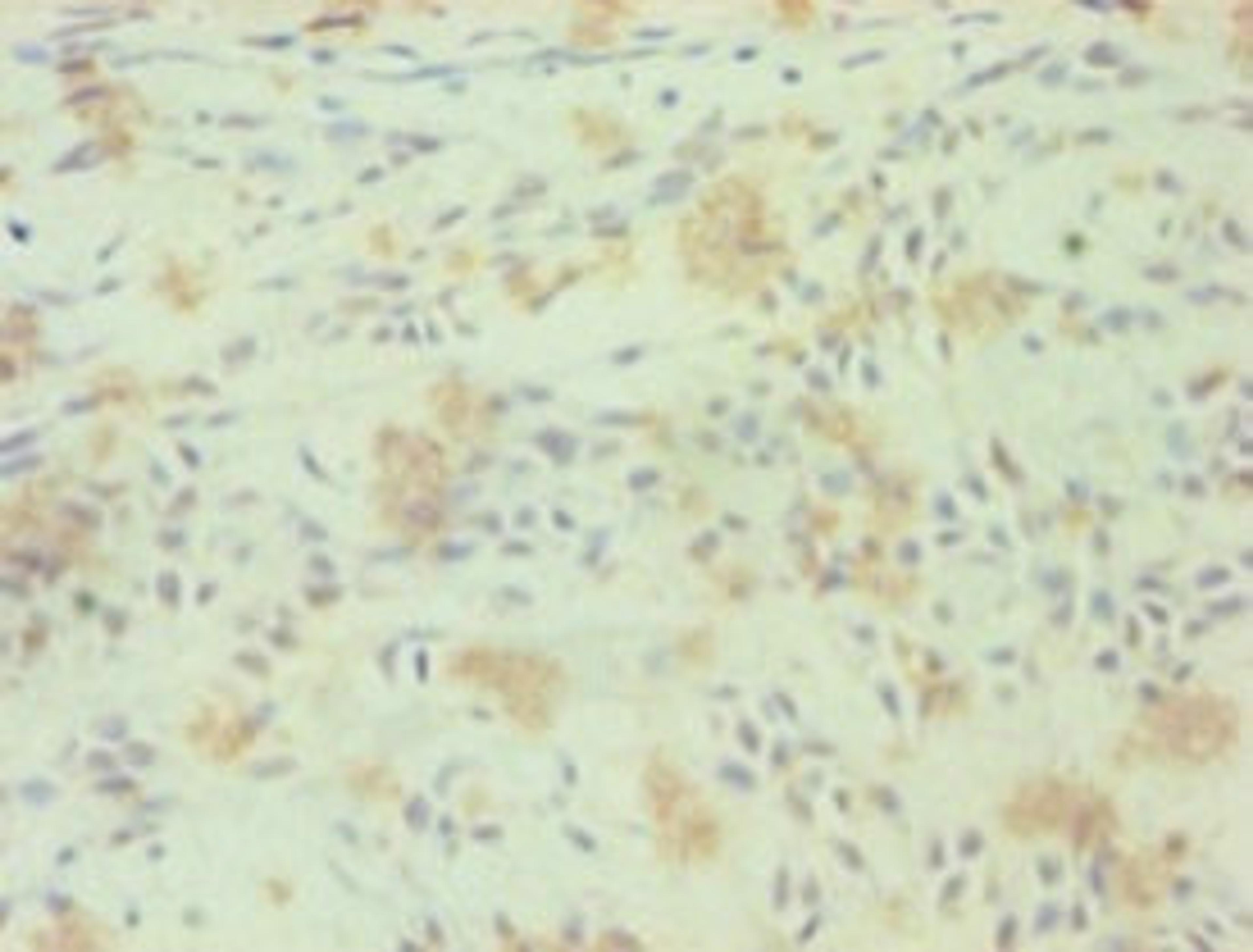 Immunohistochemistry of paraffin-embedded human breast cancer using CSB-PA020071LA01HU at dilution of 1:100