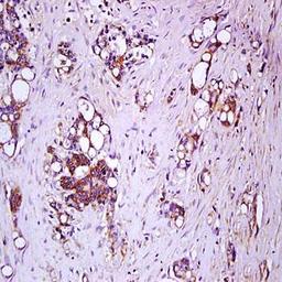 Immunohistochemical analysis of formalin-fixed and paraffin embedded human colon carcinoma tissue (dilution at:1:200) using IL17 Receptor C antibody