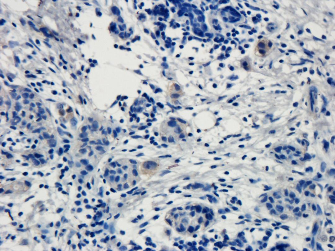 Immunohistochemical staining of human breast cancer tissue using anti-TRPV1 (dilution of primary antibody - 1:100)