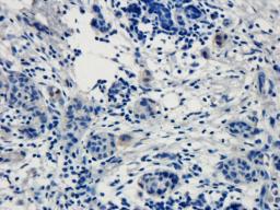 Immunohistochemical staining of human breast cancer tissue using anti-TRPV1 (dilution of primary antibody - 1:100)