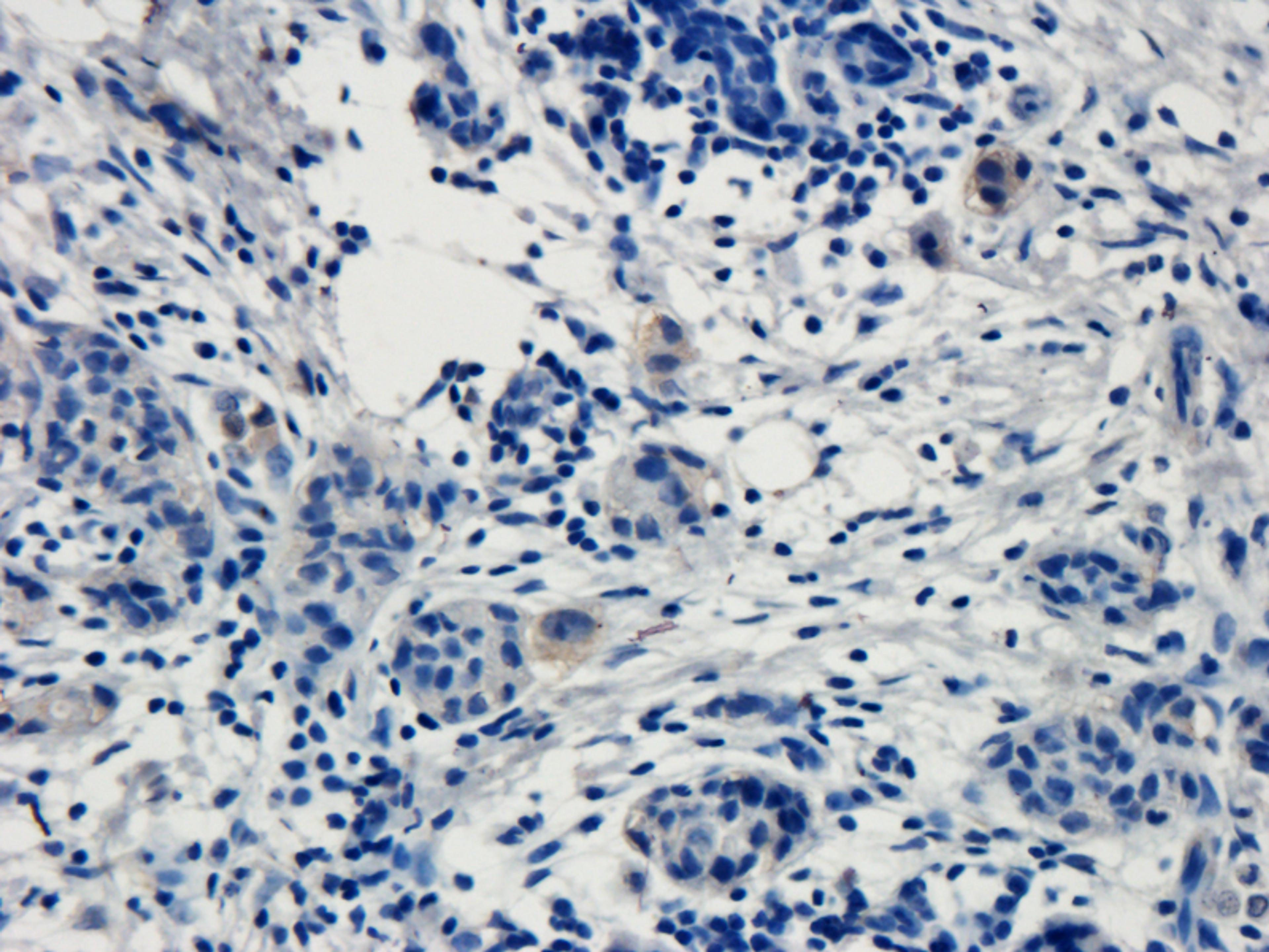 Immunohistochemical staining of human breast cancer tissue using anti-TRPV1 (dilution of primary antibody - 1:100)