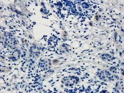 Immunohistochemical staining of human breast cancer tissue using anti-TRPV1 (dilution of primary antibody - 1:100)