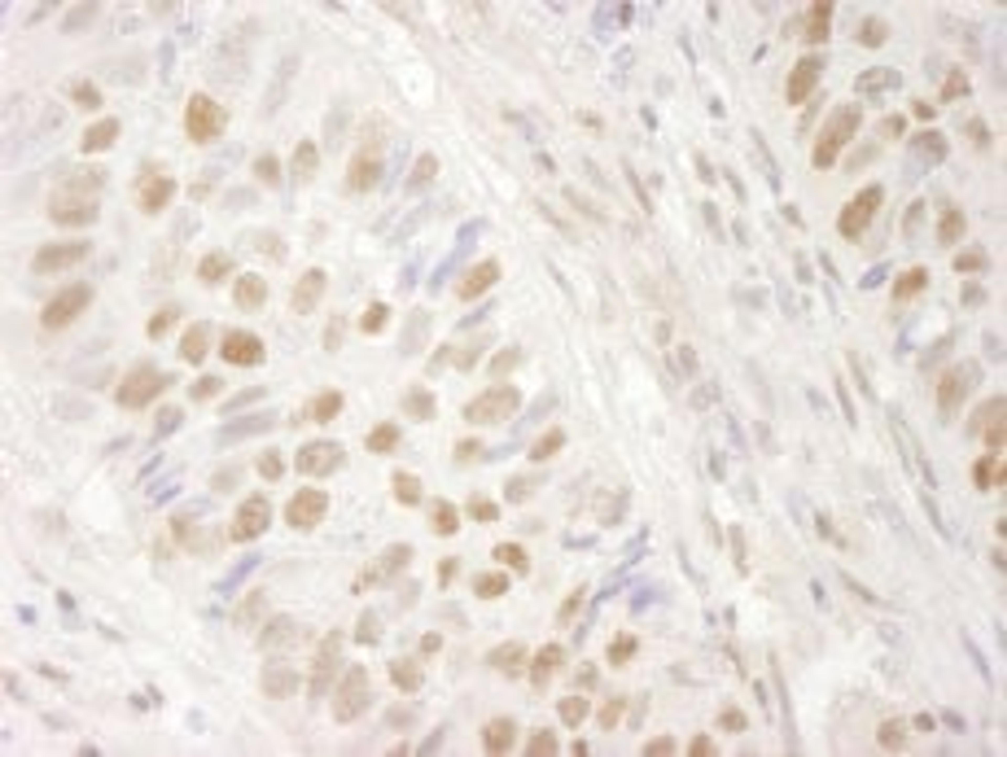 Detection of human BRG1/SMARCA4 by immunohistochemistry.