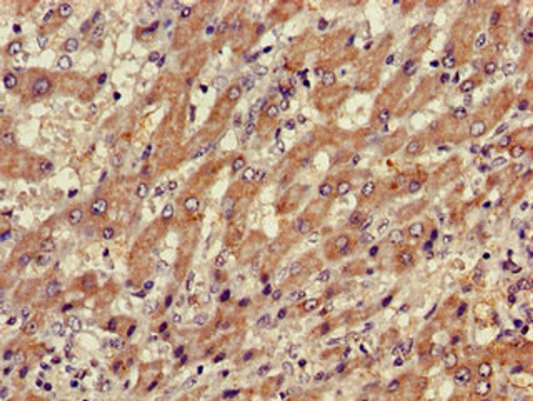 Immunohistochemistry of paraffin-embedded human liver cancer using CSB-PA05319A0Rb at dilution of 1:100