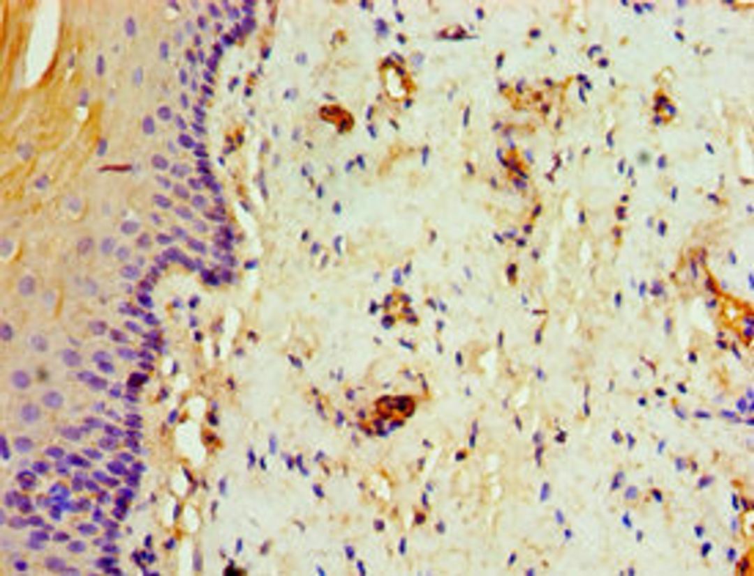 Immunohistochemistry of paraffin-embedded human cervical cancer using CSB-PA023120ESR1HU at dilution of 1:100