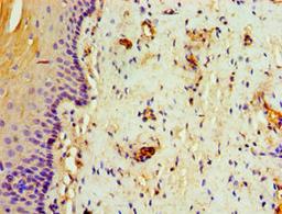 Immunohistochemistry of paraffin-embedded human cervical cancer using CSB-PA023120ESR1HU at dilution of 1:100