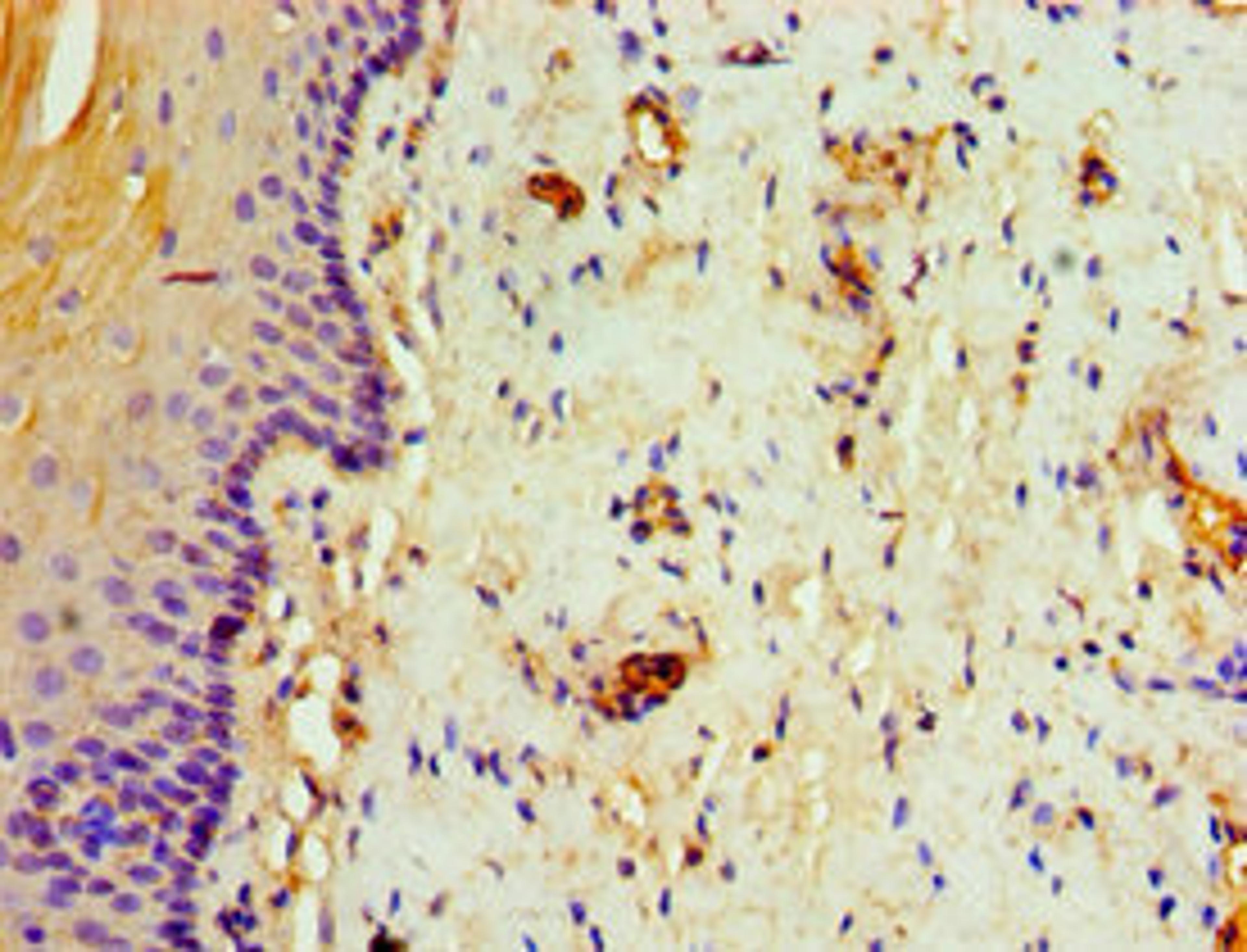 Immunohistochemistry of paraffin-embedded human cervical cancer using CSB-PA023120ESR1HU at dilution of 1:100