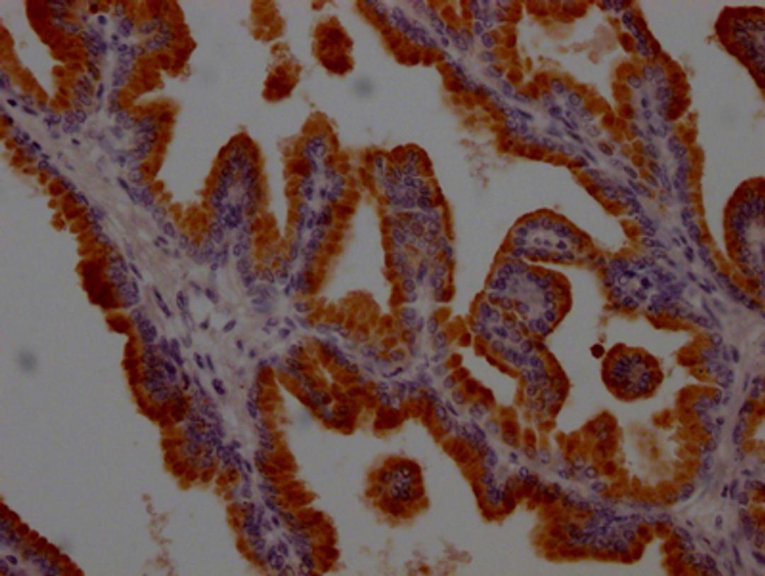 IHC image of CSB-RA548583A0HU diluted at 1:100 and staining in paraffin-embedded human prostate tissue performed on a Leica BondTM system. After dewaxing and hydration, antigen retrieval was mediated by high pressure in a citrate buffer (pH 6.0). Section was blocked with 10% normal goat serum 30min at RT. Then primary antibody (1% BSA) was incubated at 4℃ overnight. The primary is detected by a Goat anti-rabbit IgG polymer labeled by HRP and visualized using 0.05% DAB.