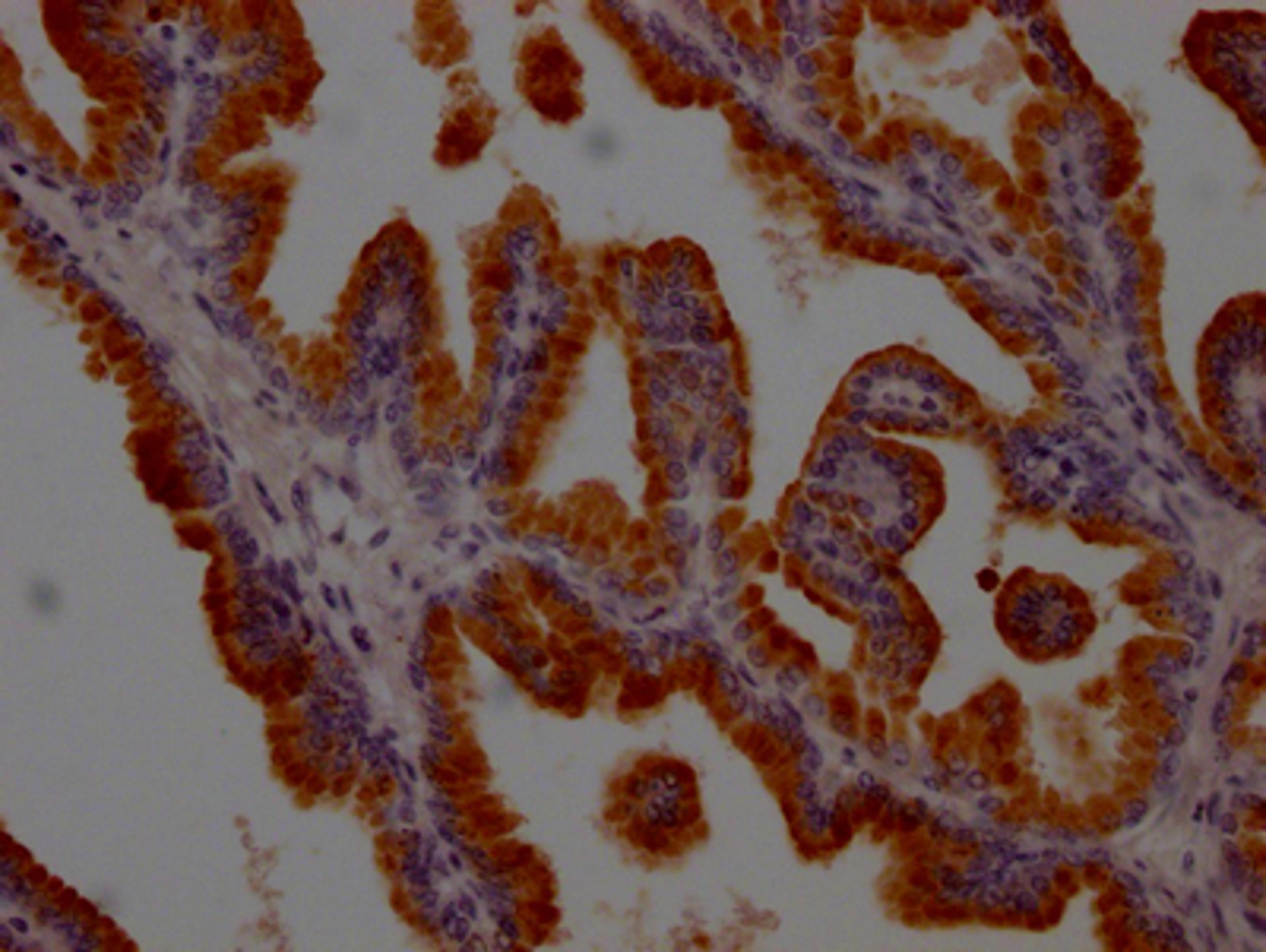 IHC image of CSB-RA548583A0HU diluted at 1:100 and staining in paraffin-embedded human prostate tissue performed on a Leica BondTM system. After dewaxing and hydration, antigen retrieval was mediated by high pressure in a citrate buffer (pH 6.0). Section was blocked with 10% normal goat serum 30min at RT. Then primary antibody (1% BSA) was incubated at 4℃ overnight. The primary is detected by a Goat anti-rabbit IgG polymer labeled by HRP and visualized using 0.05% DAB.