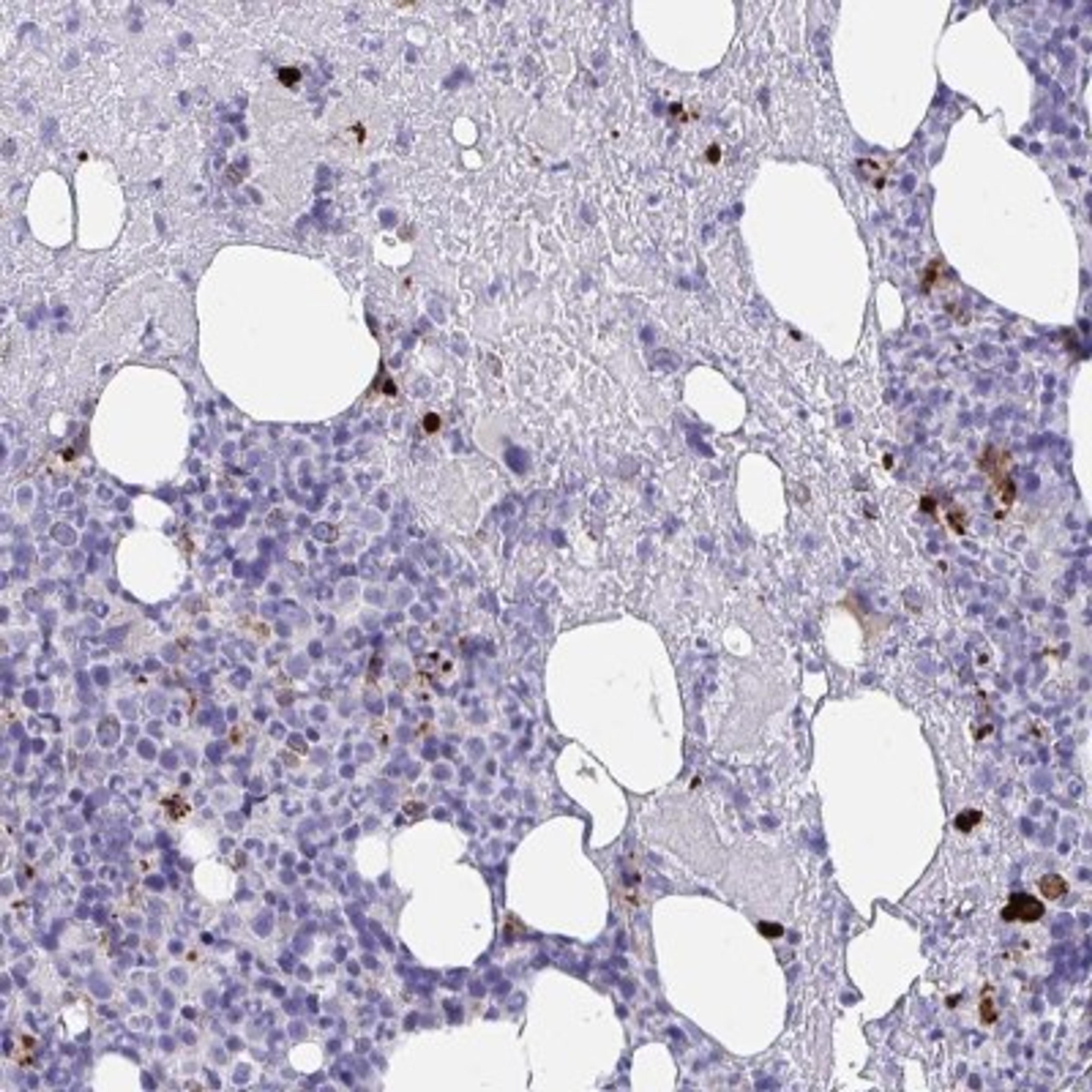 Immunohistochemistry-Paraffin: MLL5 Antibody [NBP2-33775] - Immunohistochemical staining of human bone marrow shows strong positivity in a subset of hematopoietic cells.