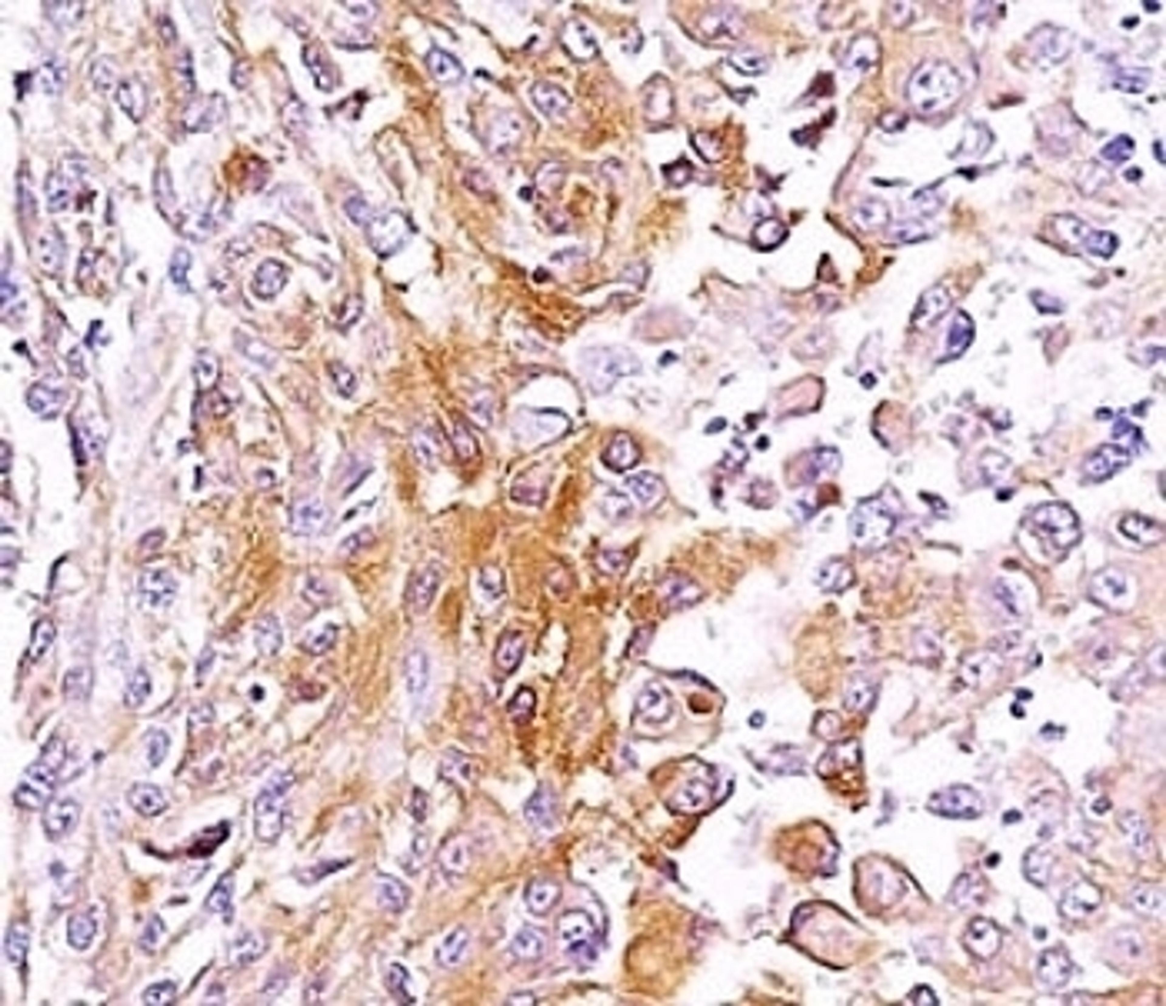 Formalin-fixed, paraffin-embedded human melanoma stained with anti-gp100 antibody (SPM286).