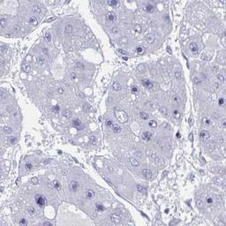 Immunohistochemistry: SPATS2L Antibody [NBP2-31605] - liver cancer