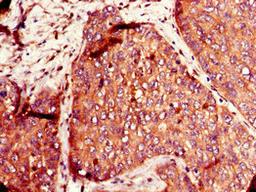 Immunohistochemistry of paraffin-embedded human ovarian cancer using CSB-PA893907LA01HU at dilution of 1:100