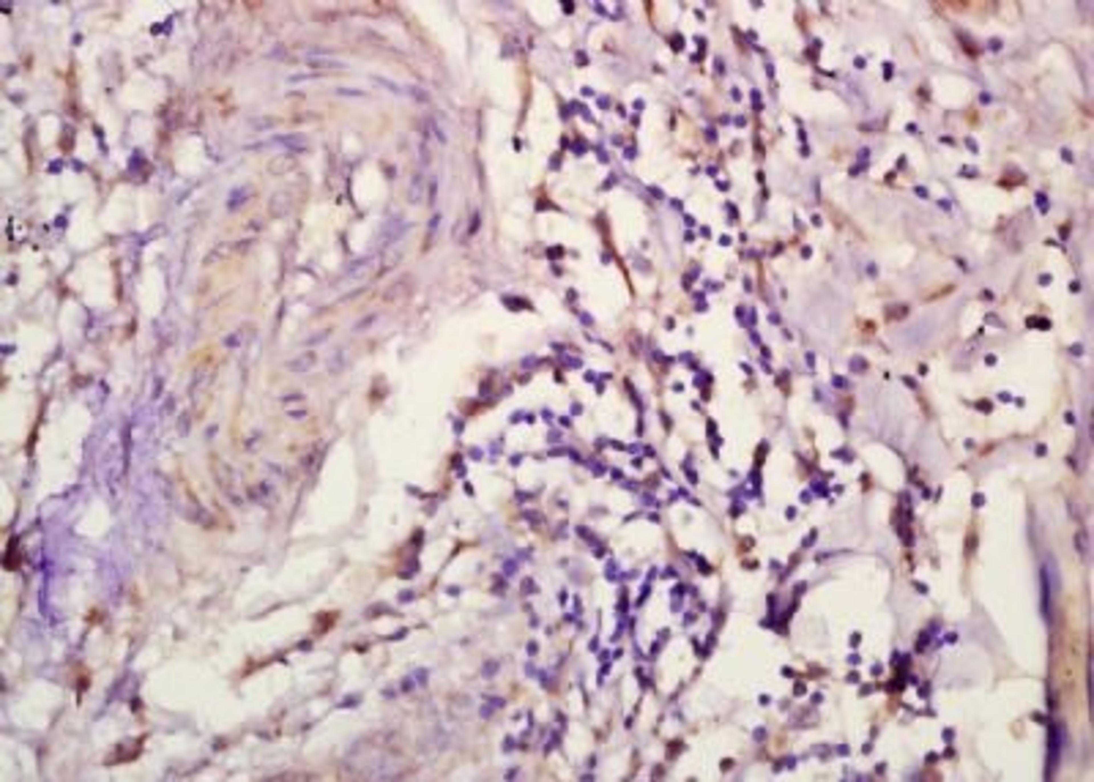 Immunohistochemical analysis of formalin-fixed paraffin embedded human lung carcinoma tissue using CXCL3 antibody (dilution at 1:200)