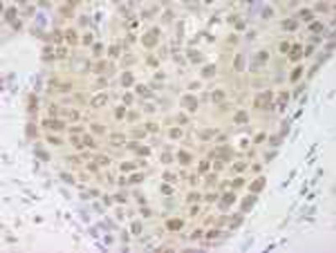 Immunohistochemistry-Paraffin: Cullin 4a Antibody [NB100-2267] - FFPE section of human breast tumor.  Affinity purified rabbit anti-Cul4a used at a dilution of 1:500.